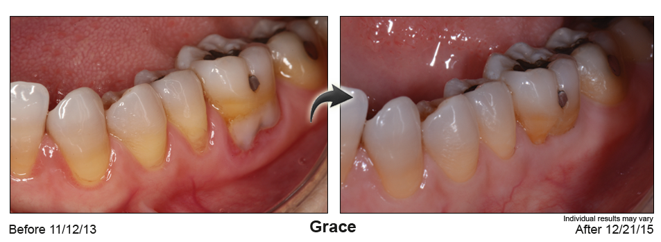 fix gum recession Alpharetta Georgia