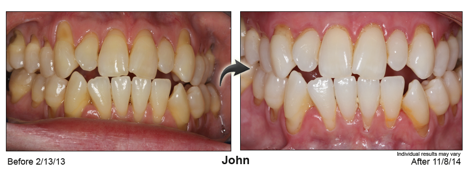 Alpharetta Georgia gum recession