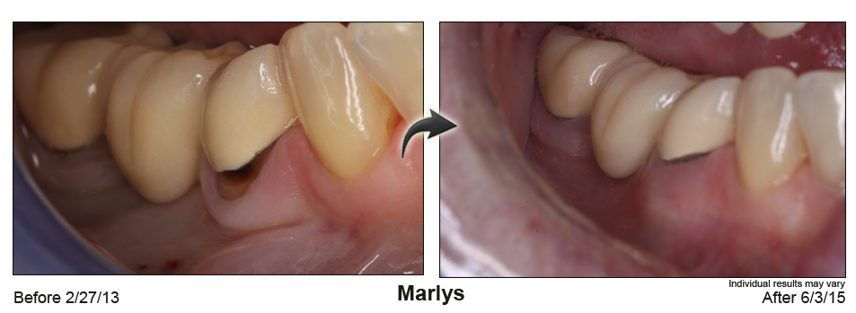 fix receding gums Alpharetta Georgia